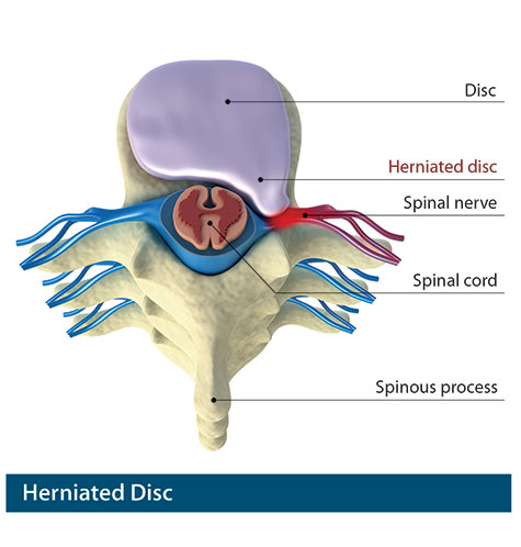 Herniated and Bulging disc