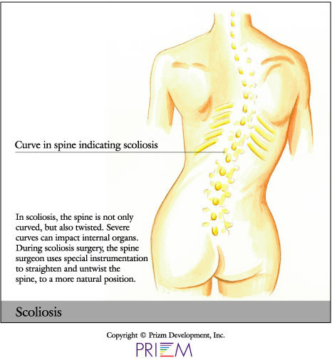 Herniated Disc Cervical/ACDF - Slipped Disc in the Neck - Little Rock, AR &  North Little Rock, AR: Martin Orthopedics