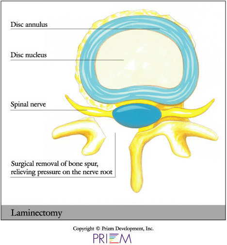 laminoplasty and laminectomy for spinal stenosis in the neck